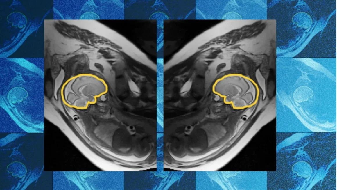 Breaking the Motion Barrier: How AI is Revolutionizing Fetal Brain Imaging