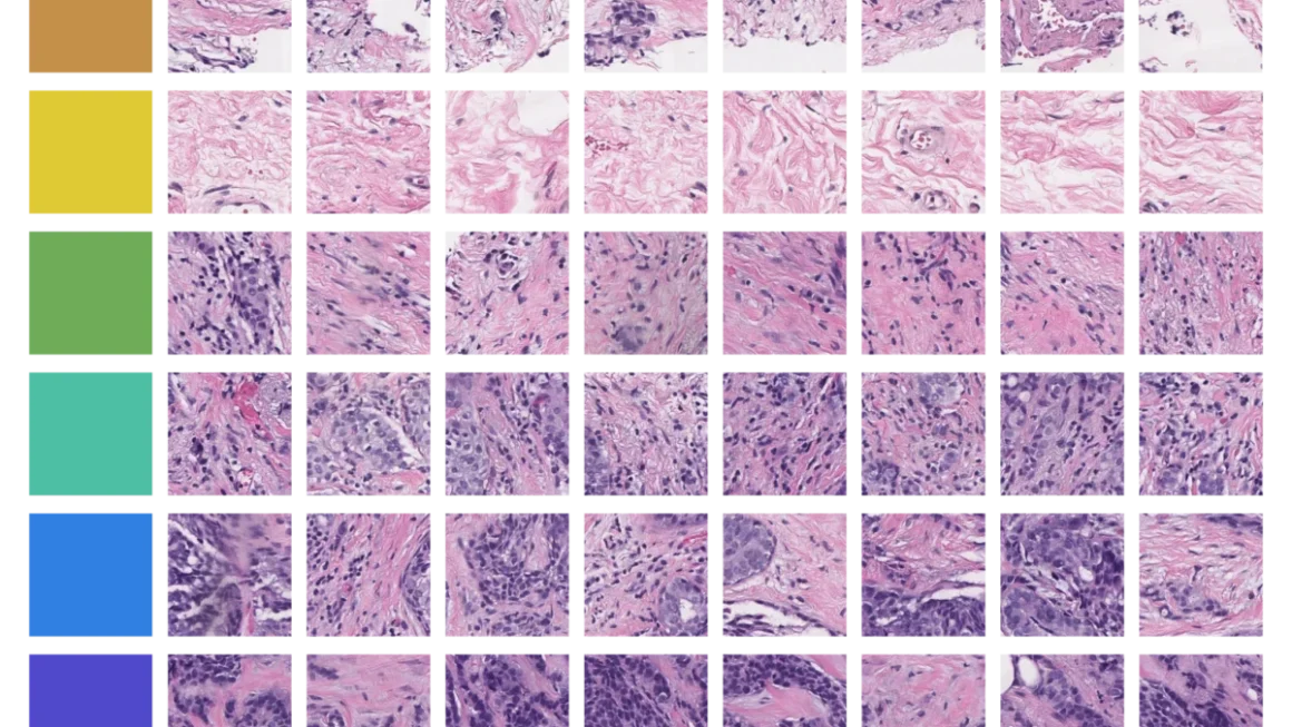 From Scan to Treatment Plan, AI Helps Close Breast Cancer’s Deadliest Gaps